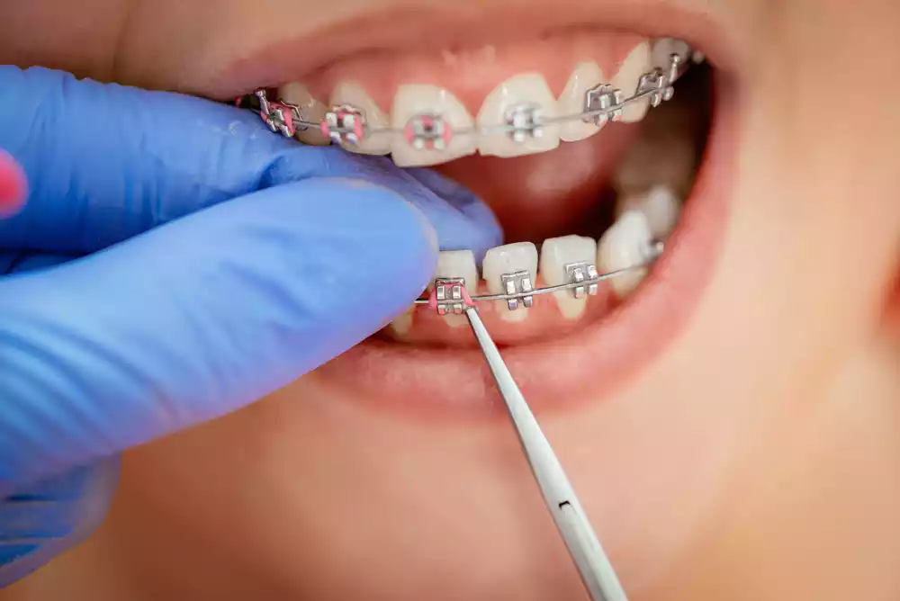 dental braces in Tijuana
