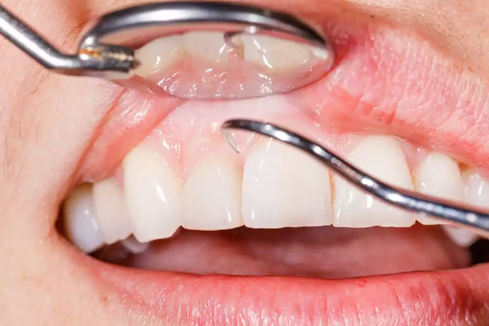 gum disease effects
