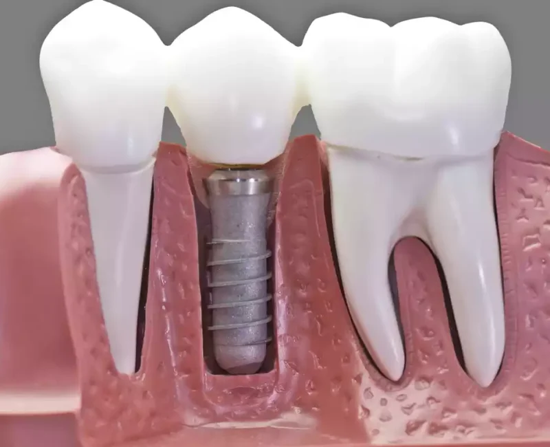 dental implants (4)