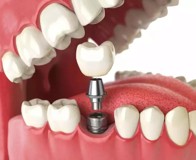 dental implants (5)