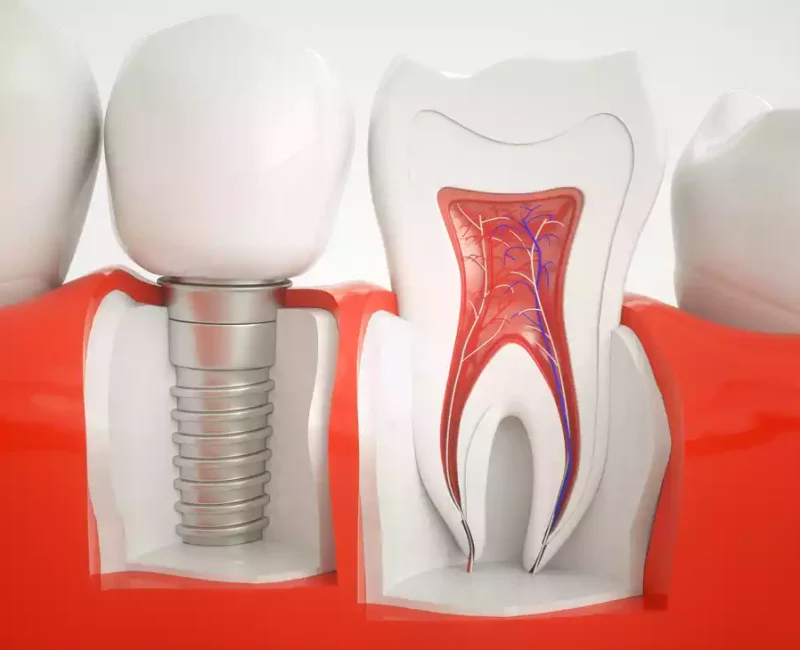 dental implants (7)