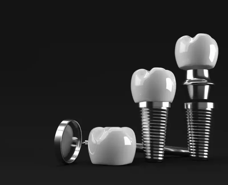 dental implants in Tijuana